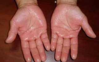 Когда потеют руки — что делать?