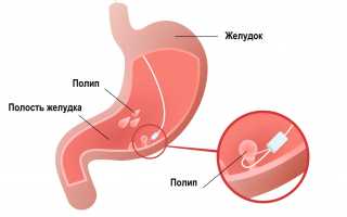Полип в желудке. Симптомы, причины, чем опасен, диета, лечение народными средствами, психосоматика