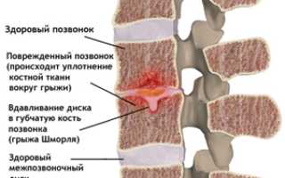 Особенности грыжи Шморля и принципы лечения позвоночника