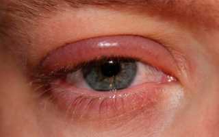 Опухшие глаза утром. Причины верхнее, нижнее веко, как убрать, избавиться от отеков