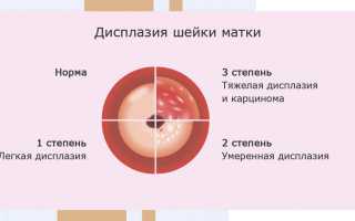 Заболевания шейки матки. Список, классификация, клинические рекомендации