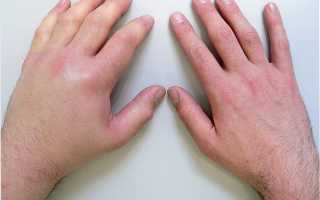 Вывих руки — что делать?