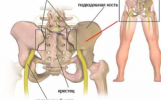 Cакроилеит: что это такое, какой прогноз, лечение