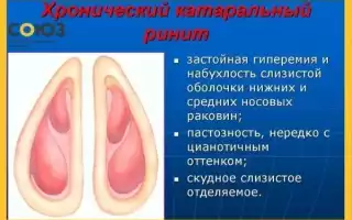 Ринит. Симптомы и лечение у взрослых: атрофический, аллергический, вазомоторный, гнойный