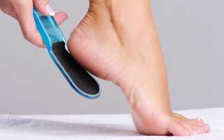 Потрескались пятки. Причины, лечение в домашних условиях, мази, перекись водорода