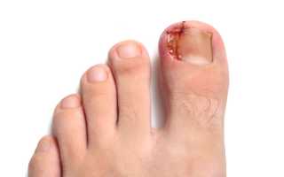 Панариций пальца на ноге. Симптомы и лечение