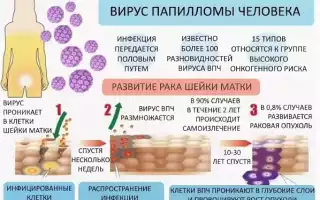 Лечение ВПЧ у женщин. Препараты, схема, клинические рекомендации врачей