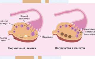 Дисфункция яичников. Что это такое у женщин, подростков, симптомы, лечение, причины