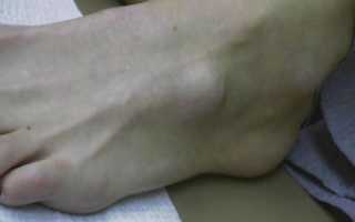 Гигрома на пальцах и подъеме стопы: симптомы и лечение