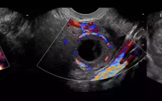 Желтое тело в яичнике — что это такое на узи при беременности, задержке, перед, после месячных, овуляции. Тест положительный и отрицательный
