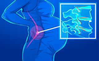 Болит поясница. Причины у женщин после сна, при месячных, беременности, сзади, слева, справа. Лечение