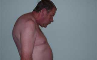 Симптомы проявления болезни Бехтерева у мужчин