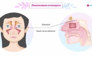 Этмоидит: симптомы и лечение. Хронический, острый, полипозный, катаральный, двусторонний. Как лечить заболевание головного мозга