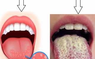 Жжение языка, неба, губ, горла. Причины и лечение у взрослых народными средствами