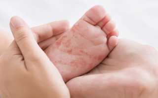 Потеют ступни ног и ладони. Причины у взрослого, подростка, ребенка-грудничка