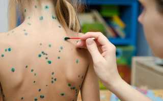 Ветрянка у детей: начало, симптомы, лечение в домашних условиях, инкубационный период, профилактика. Советы Комаровского