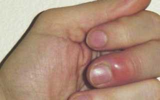 Нарывает палец после маникюра: Почему? Что это значит? Как лечить?