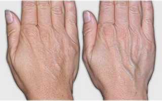 Вздутые вены на руках