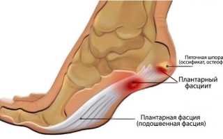 Причины боли в пятке, если больно наступать утром, при ходьбе. Лечение народными средствами, препараты