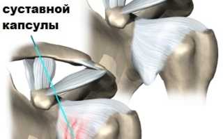 Замороженное плечо — симптомы и лечение