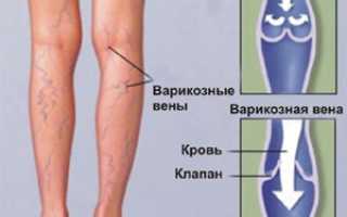 Тяжесть в ногах. Причины у женщин, мужчин ниже, выше колена, лечение, к какому врачу обратиться