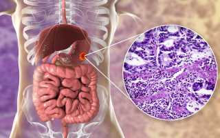 Аденокарцинома желудка. Что это, прогноз, лечение