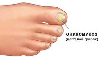 Грибок ногтей на ногах – симптомы, чем лечить в домашних условиях народными средствами и медикаментозно