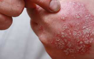 Красное пятно на коже чешется и шелушится у взрослого и ребенка. Что делать, чем лечить
