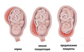 Низкая плацентация при беременности 12-19-20-21 недель. Что это значит