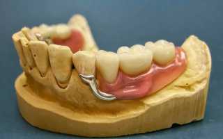 Бюгельные протезы на нижнюю/верхнюю челюсть. Фото на кламмерах, аттачменах, замках, шинирующий, квадротти