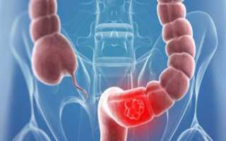 Дискинезия кишечника (толстой кишки). Что это такое у детей, лечение, симптомы