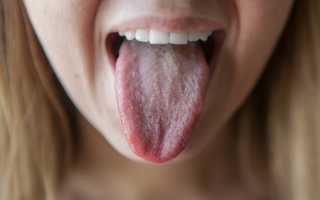 Белый язык у взрослого. Причины и лечение народными средствами. Симптомы, признаки