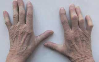 Полиартрит: что это такое, причины болезни и симптомы, лечение