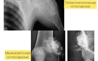 Саркома тазобедренного сустава. Симптомы у детей, что такое остеогенная, синовиальная, Юинга, признаки, лечение, фото