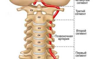Гипоплазия правой позвоночной артерии. Что это, симптомы, лечение