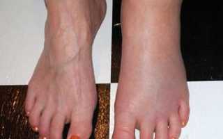 Причины боли в стопе ноги: виды заболеваний и лечение