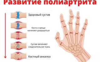 Полиартрит. Что такое, как, чем лечить
