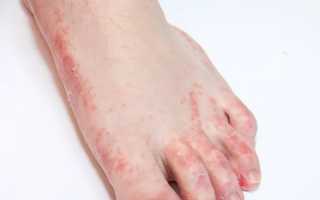 Экзема на ногах. Причины и лечение, народные средства, диета, препараты