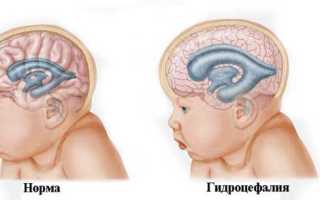 Перинатальная энцефалопатия. Что это такое у детей, взрослых, симптомы, последствия