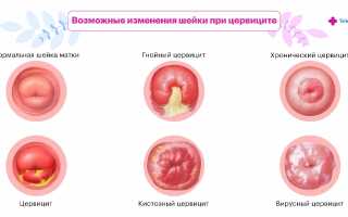 Хронический церцевит шейки матки. Лечение травами, средствами