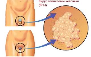 ВПЧ высокого онкогенного риска. Анализы, лечение у женщин, мужчин