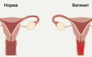 Бактериальный вагинит. Симптомы и лечение хронический, подострый, свечи при беременности