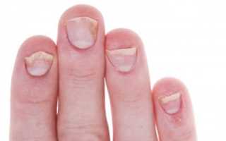 Проблема вросшего ногтя на руке — как лечить медицинскими и народными методами