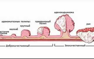 Фиброзно-железистый полип эндометрия. Что это такое, лечение после удаления