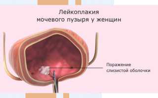 Лейкоплакия мочевого пузыря у женщин, мужчин. Что это такое, симптомы, лечение лазером, антибиотиками