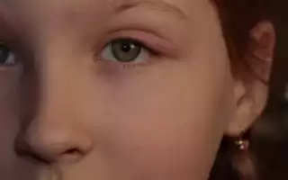 Ячмень на глазу у ребенка. Чем, как лечить быстро дома, фото, как выглядит внутренний, причины появления