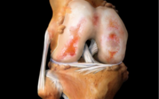 Лечение коленных суставов от гонартроза