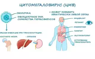 Цитомегаловирус. Лечение у женщин, препараты, схема