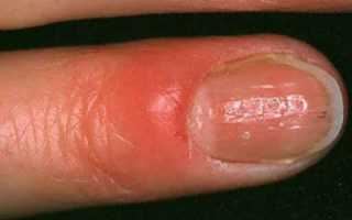 Что делать с воспалением после маникюра