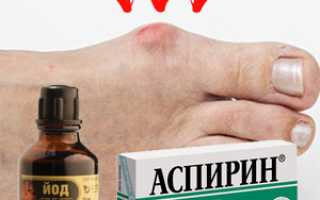 Шишка на пальце ноги. Лечение народными средствами артрита в домашних условиях: мази, кремы, рецепты народной медицины